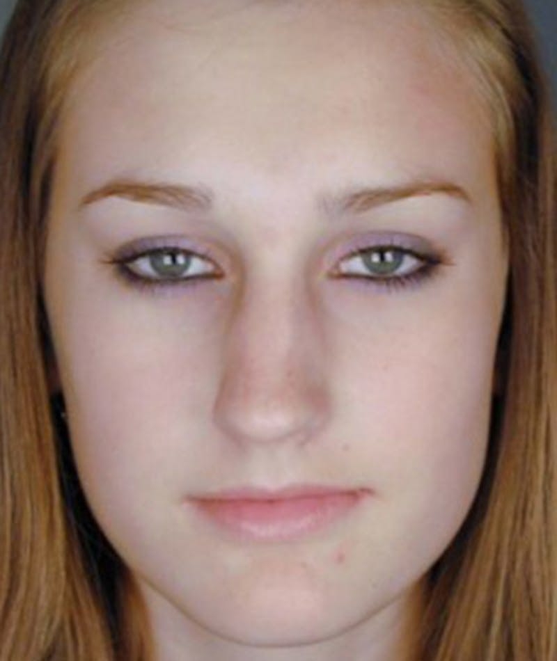 Primary Rhinoplasty Before & After Gallery - Patient 108174344 - Image 3