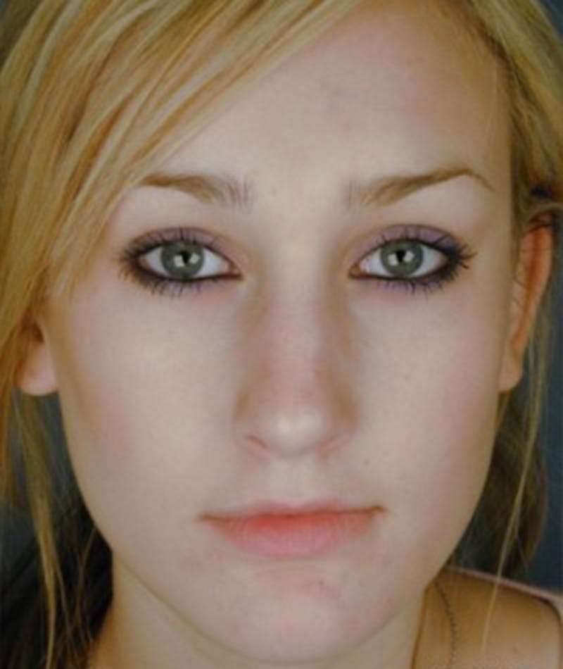 Primary Rhinoplasty Before & After Gallery - Patient 108174344 - Image 4