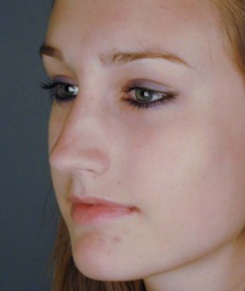 Primary Rhinoplasty Before & After Gallery - Patient 108174344 - Image 5