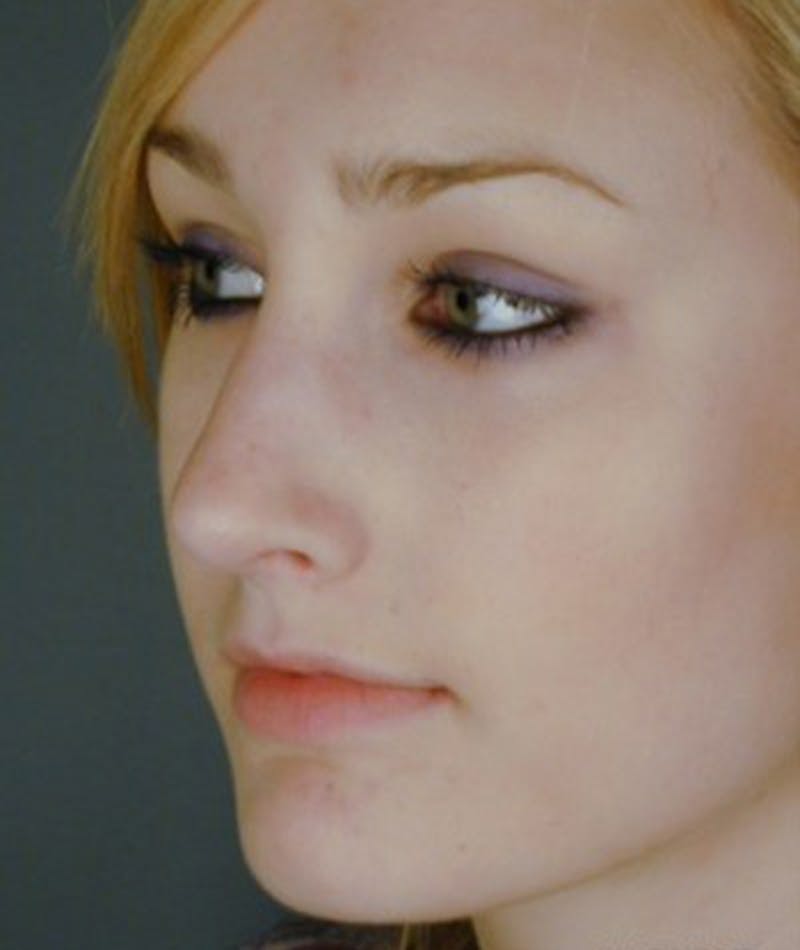 Primary Rhinoplasty Before & After Gallery - Patient 108174344 - Image 6