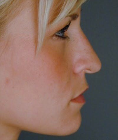 Primary Rhinoplasty Before & After Gallery - Patient 108174361 - Image 1