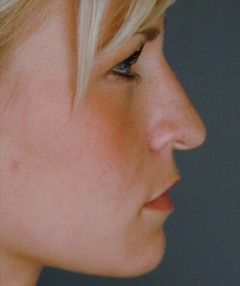 Primary Rhinoplasty Before & After Gallery - Patient 108174361 - Image 1