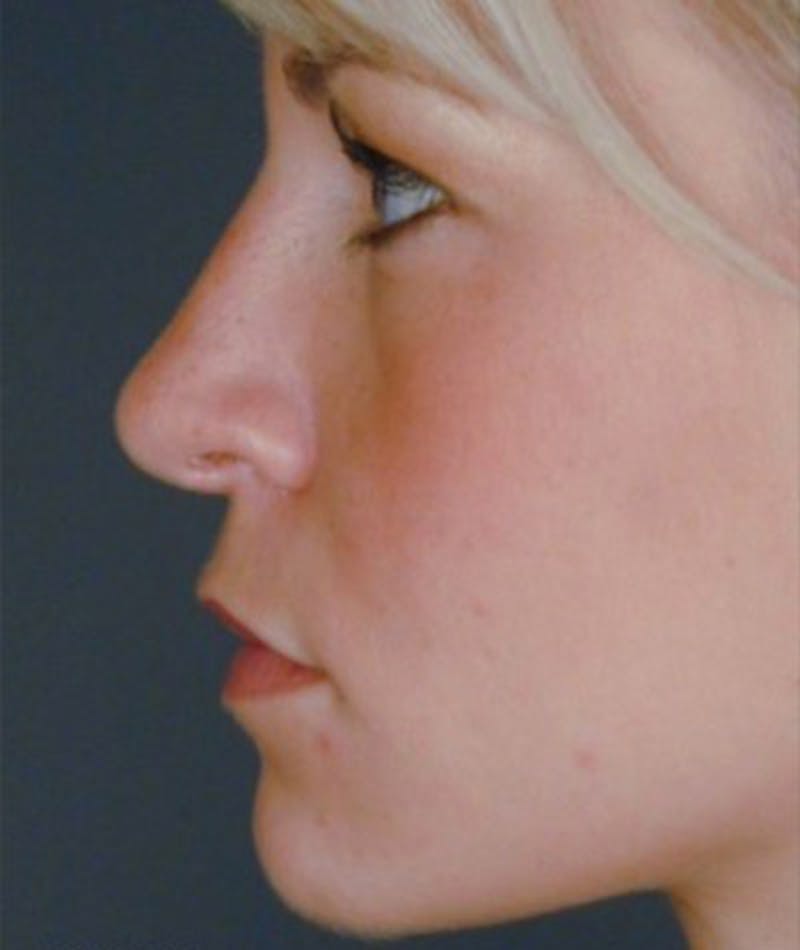 Primary Rhinoplasty Before & After Gallery - Patient 108174361 - Image 2