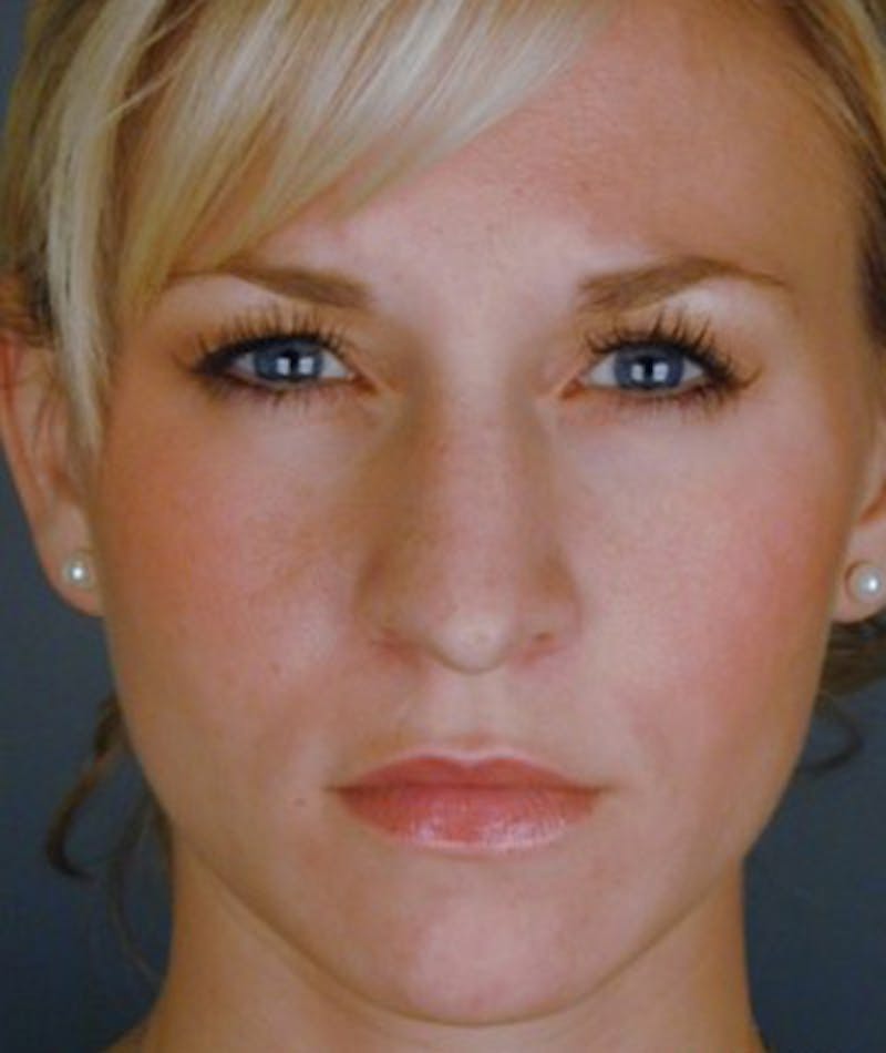 Primary Rhinoplasty Before & After Gallery - Patient 108174361 - Image 3