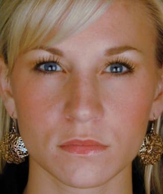 Primary Rhinoplasty Before & After Gallery - Patient 108174361 - Image 4