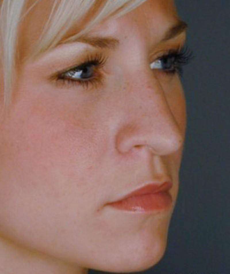 Primary Rhinoplasty Before & After Gallery - Patient 108174361 - Image 5