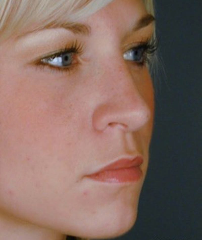 Primary Rhinoplasty Before & After Gallery - Patient 108174361 - Image 6
