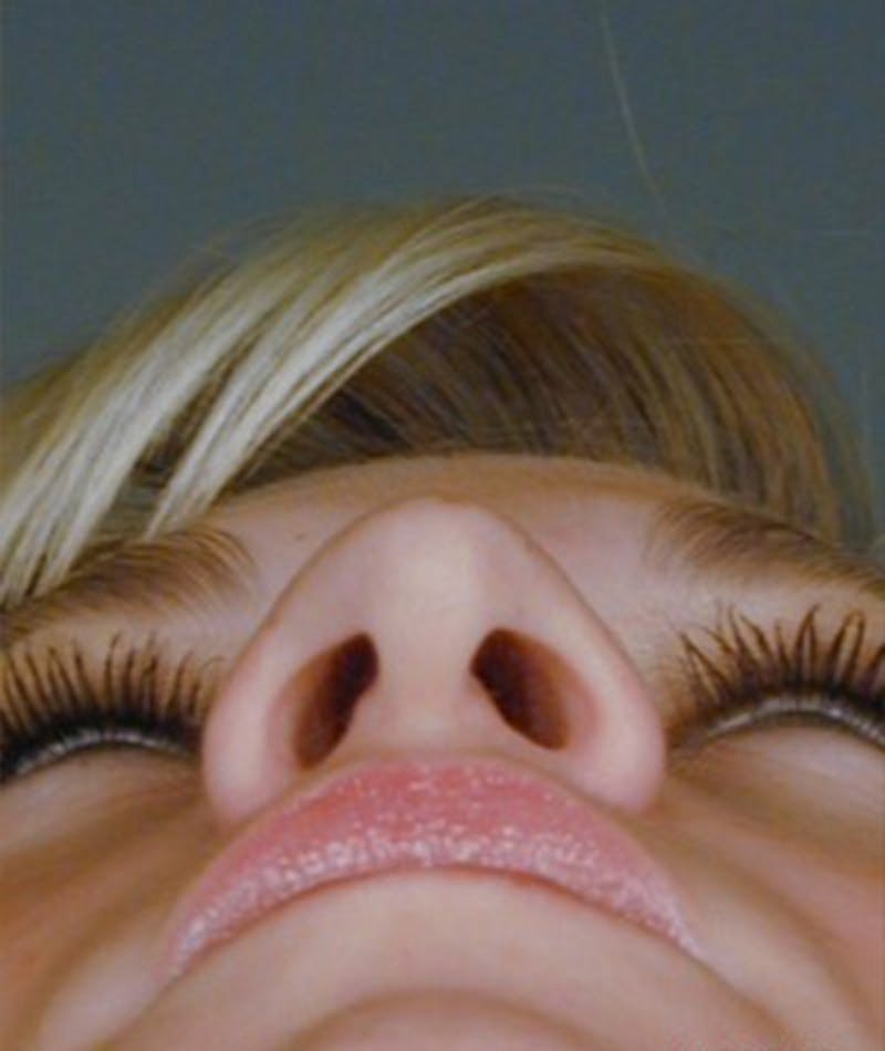 Primary Rhinoplasty Before & After Gallery - Patient 108174361 - Image 7