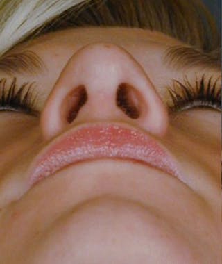 Primary Rhinoplasty Before & After Gallery - Patient 108174361 - Image 8