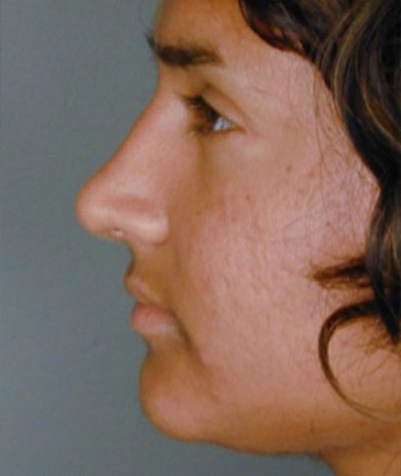 Primary Rhinoplasty Before & After Gallery - Patient 108174363 - Image 2