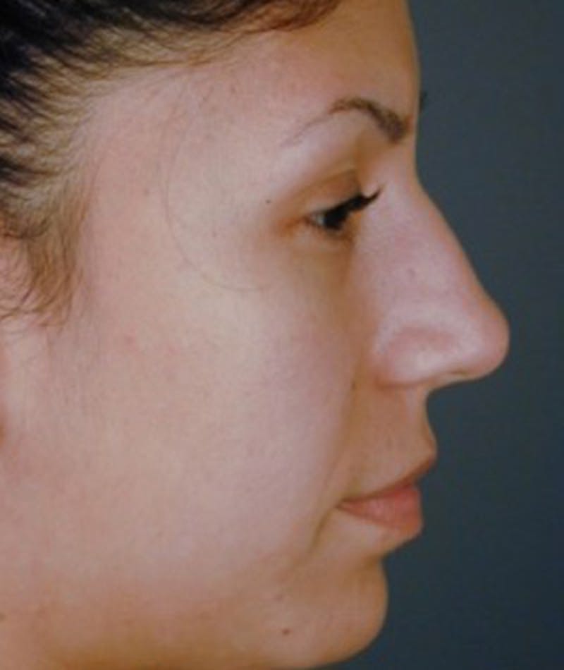 Primary Rhinoplasty Before & After Gallery - Patient 108174454 - Image 1