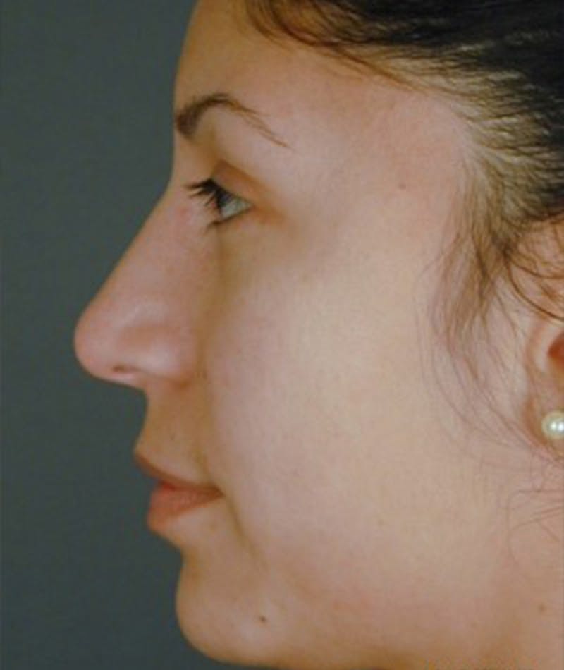 Primary Rhinoplasty Before & After Gallery - Patient 108174454 - Image 2
