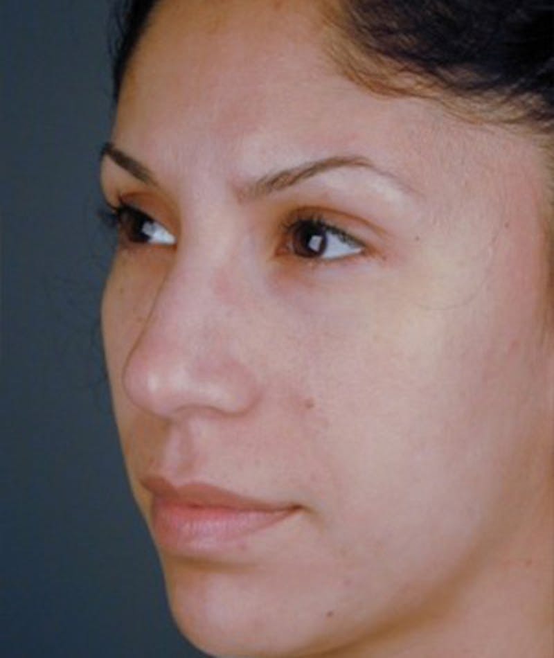 Primary Rhinoplasty Before & After Gallery - Patient 108174454 - Image 5