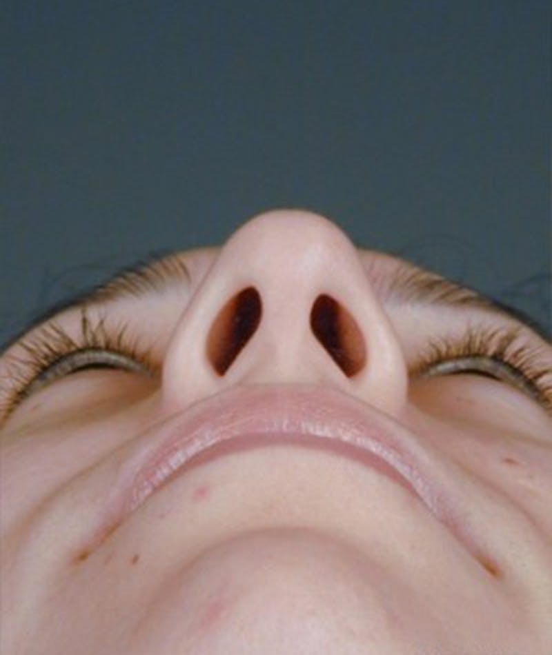 Primary Rhinoplasty Before & After Gallery - Patient 108174454 - Image 7