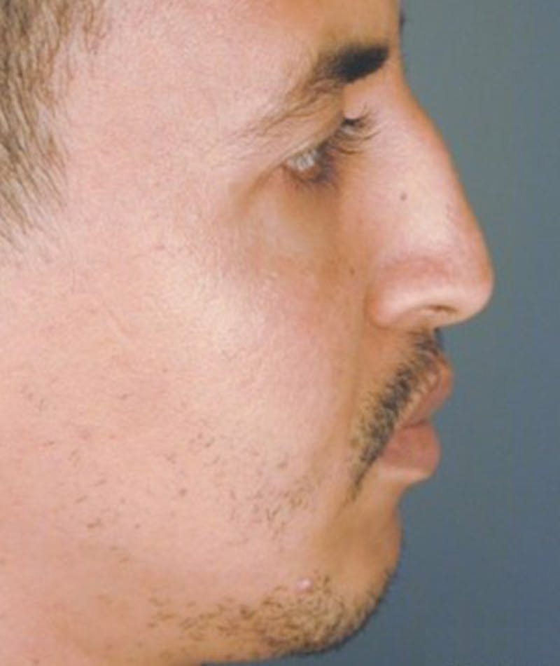 Primary Rhinoplasty Before & After Gallery - Patient 108174455 - Image 1
