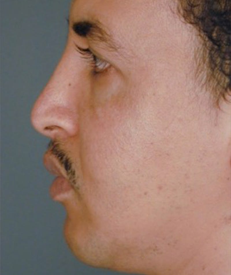 Primary Rhinoplasty Before & After Gallery - Patient 108174455 - Image 2