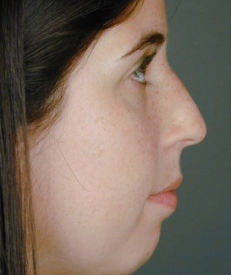 Primary Rhinoplasty Before & After Gallery - Patient 108174457 - Image 1