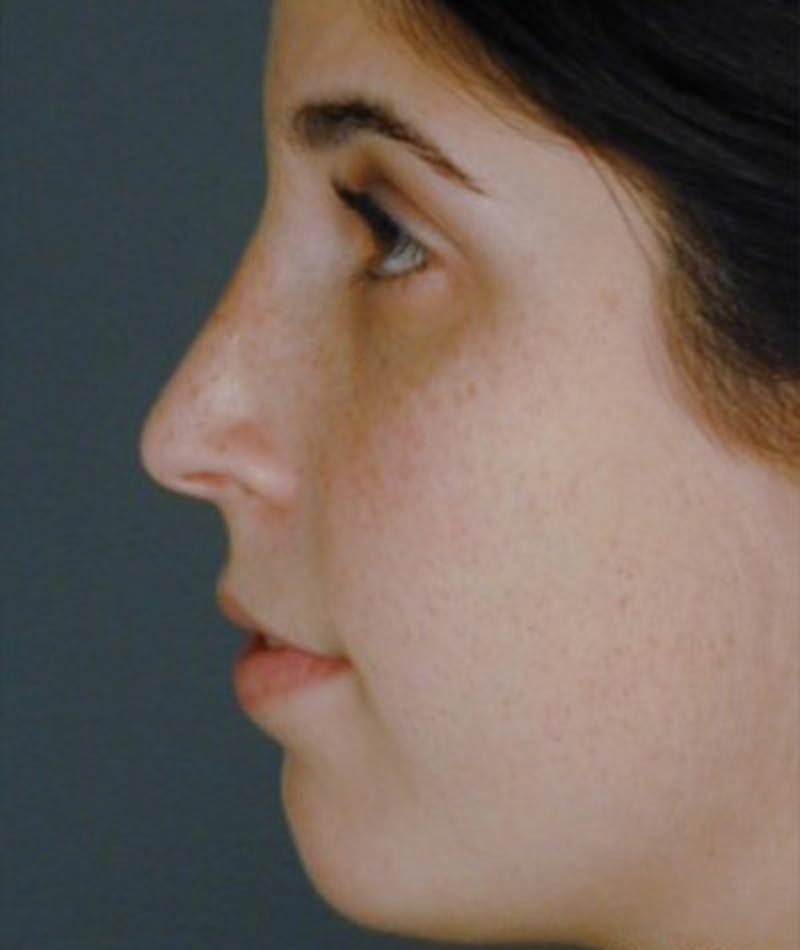 Primary Rhinoplasty Before & After Gallery - Patient 108174457 - Image 2