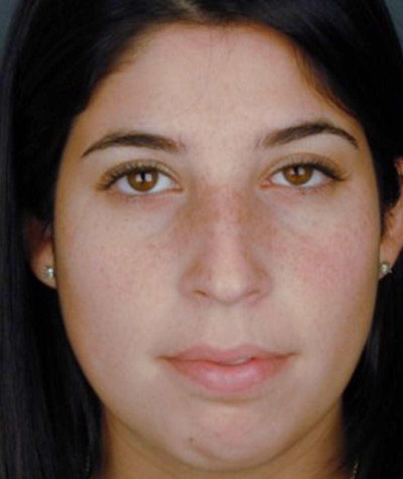 Primary Rhinoplasty Before & After Gallery - Patient 108174457 - Image 3