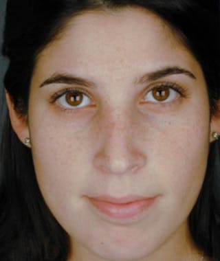 Primary Rhinoplasty Before & After Gallery - Patient 108174457 - Image 4