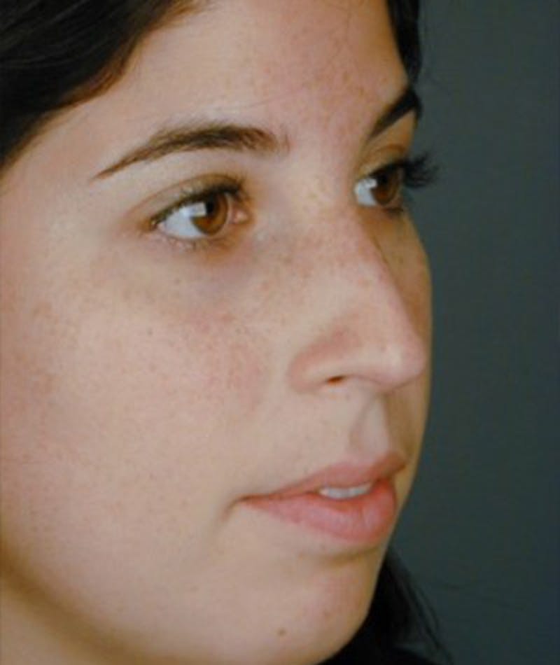 Primary Rhinoplasty Before & After Gallery - Patient 108174457 - Image 5