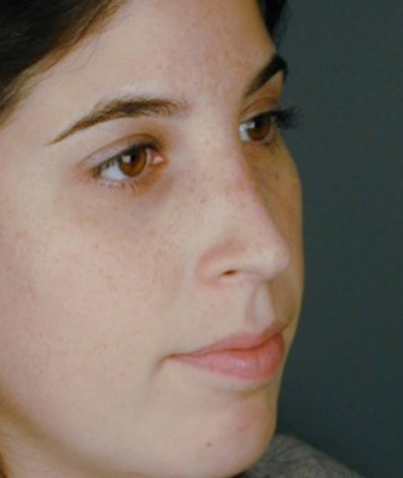 Primary Rhinoplasty Before & After Gallery - Patient 108174457 - Image 6