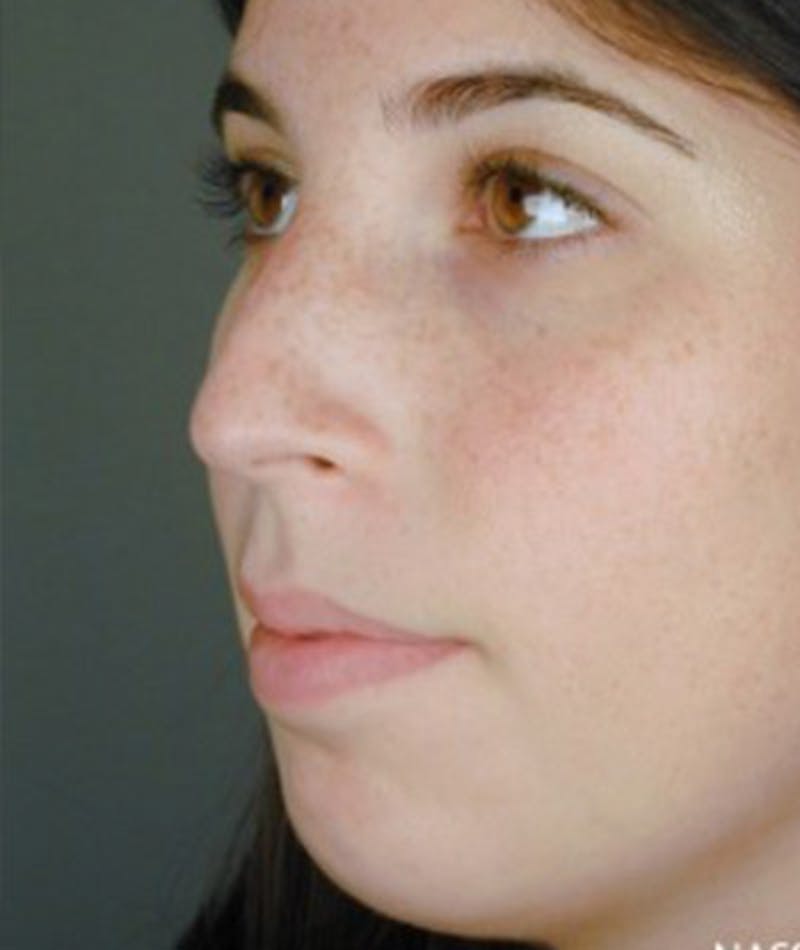 Primary Rhinoplasty Before & After Gallery - Patient 108174457 - Image 7