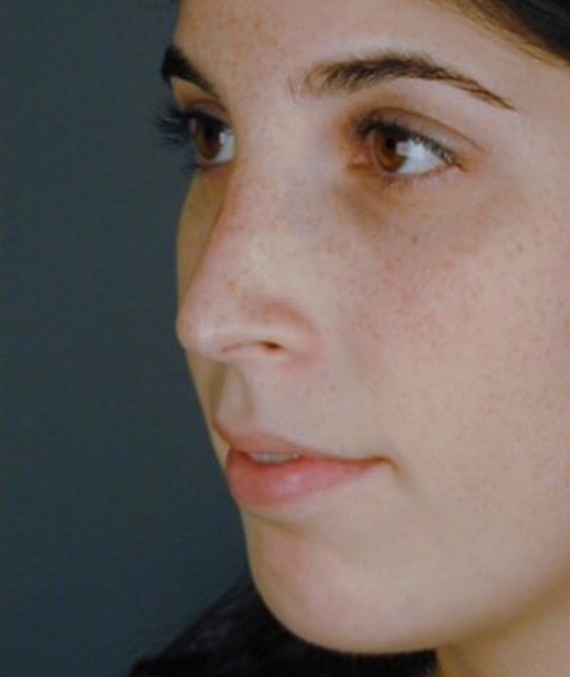 Primary Rhinoplasty Before & After Gallery - Patient 108174457 - Image 8