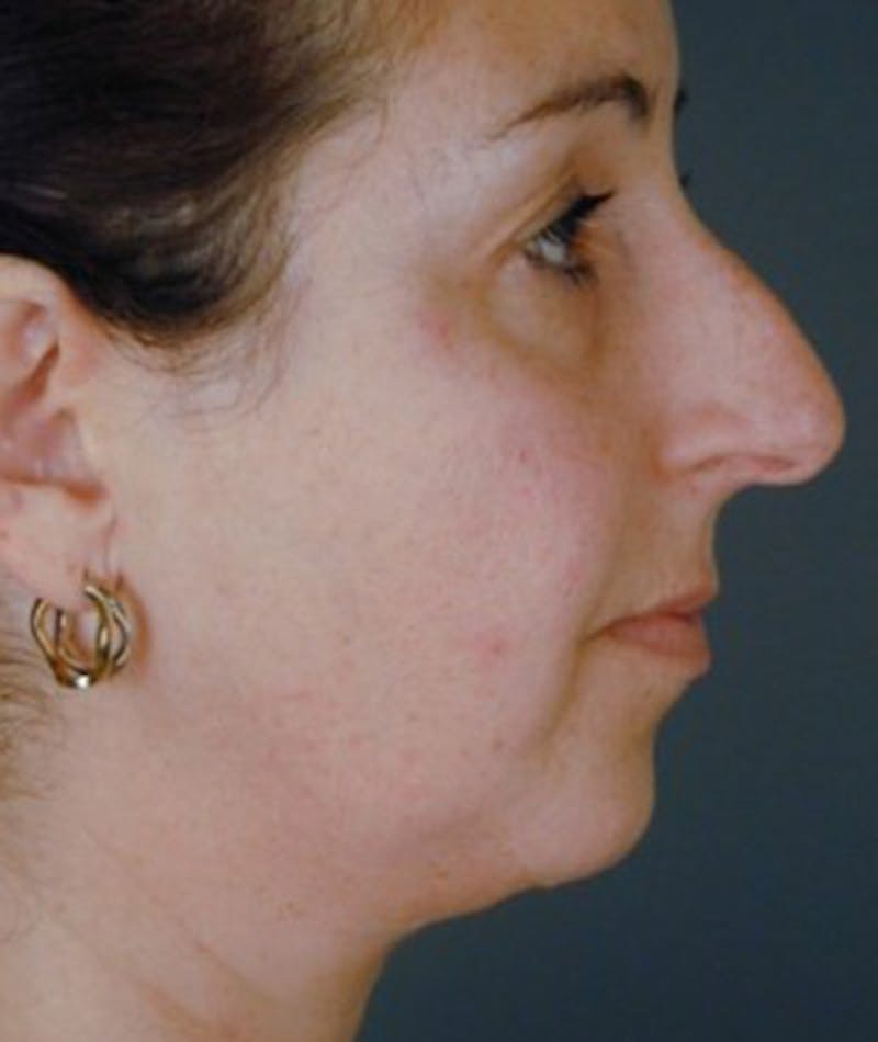 Primary Rhinoplasty Before & After Gallery - Patient 108174459 - Image 1