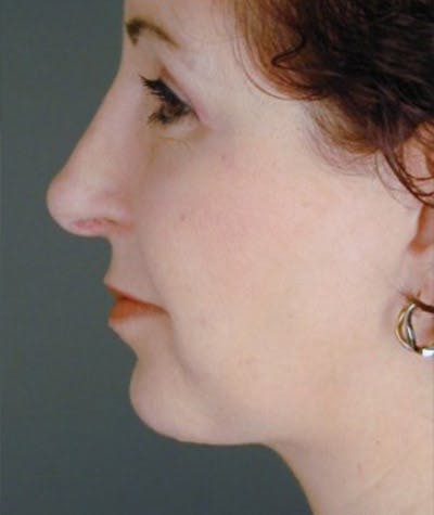 Primary Rhinoplasty Before & After Gallery - Patient 108174459 - Image 2