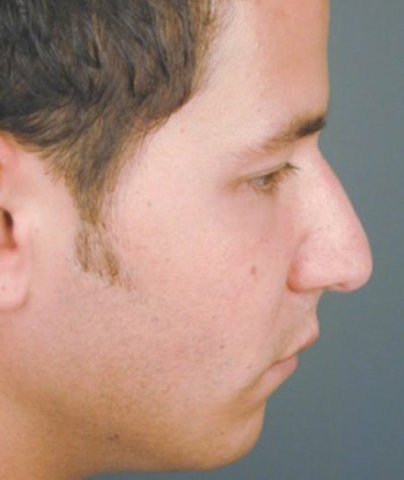 Primary Rhinoplasty Before & After Gallery - Patient 108174462 - Image 1