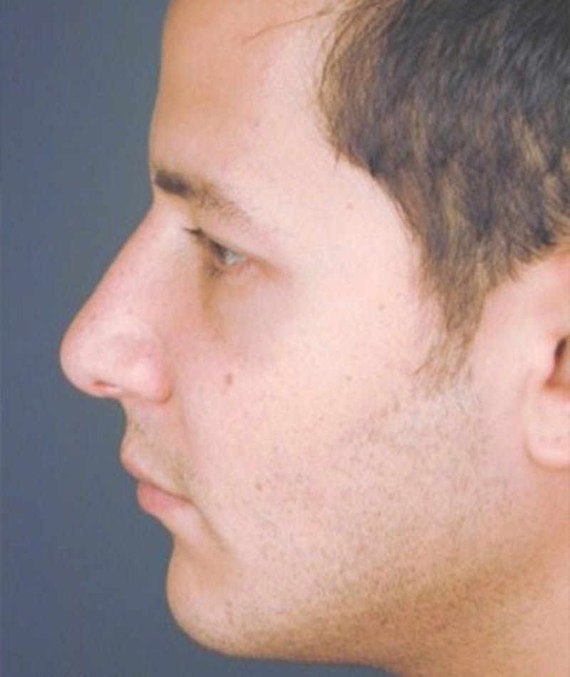 Primary Rhinoplasty Before & After Gallery - Patient 108174462 - Image 2