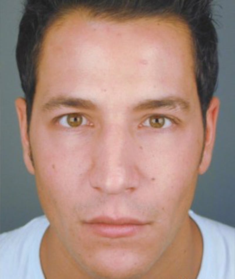 Primary Rhinoplasty Before & After Gallery - Patient 108174462 - Image 3