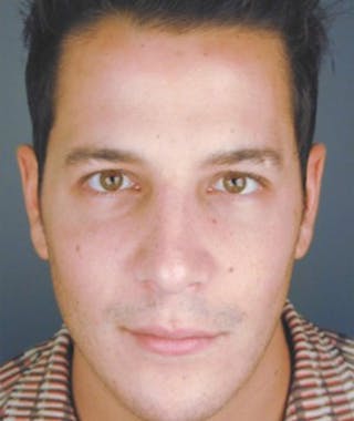 Primary Rhinoplasty Before & After Gallery - Patient 108174462 - Image 4