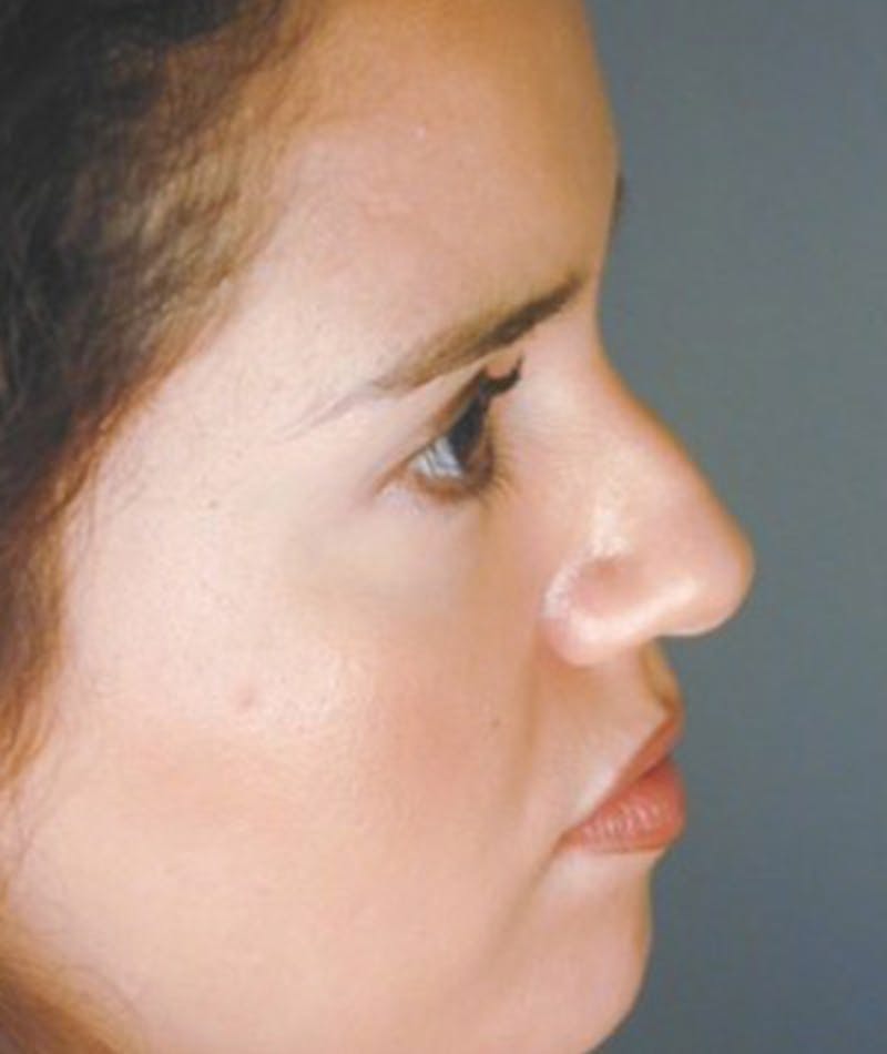 Primary Rhinoplasty Before & After Gallery - Patient 108174465 - Image 1