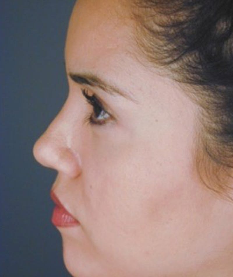 Primary Rhinoplasty Before & After Gallery - Patient 108174465 - Image 2
