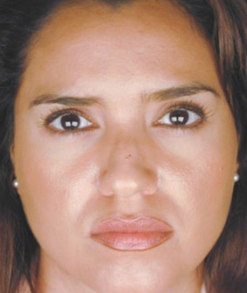 Primary Rhinoplasty Before & After Gallery - Patient 108174465 - Image 3