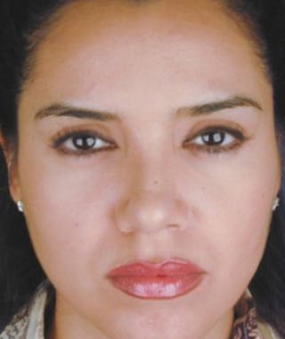 Primary Rhinoplasty Before & After Gallery - Patient 108174465 - Image 4