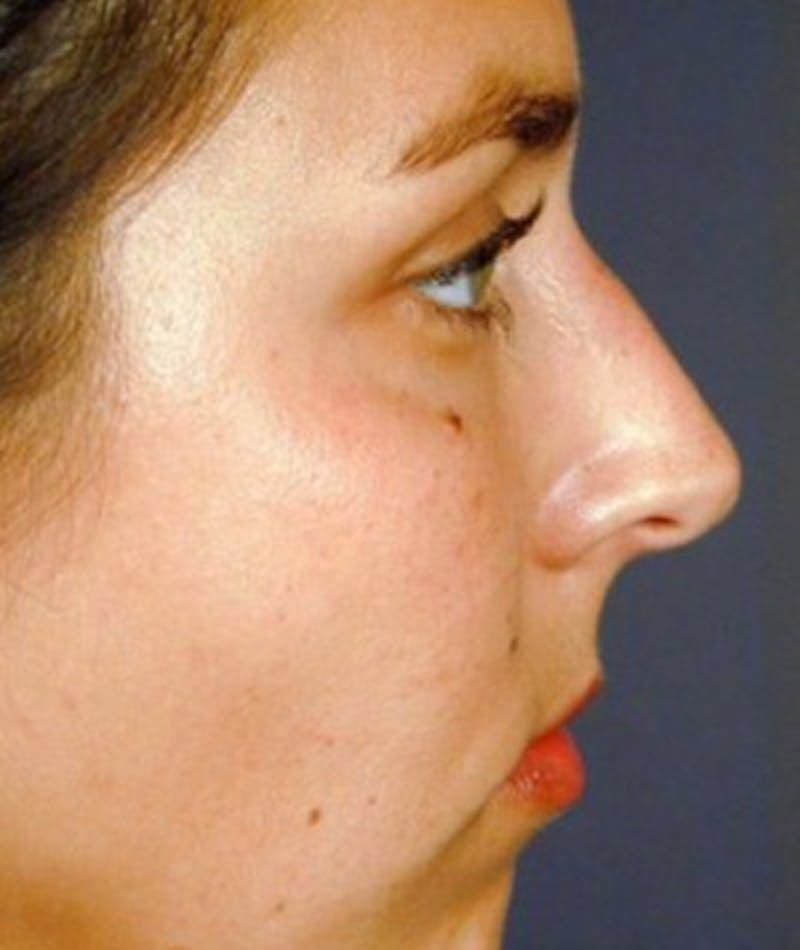 Primary Rhinoplasty Before & After Gallery - Patient 108174466 - Image 1