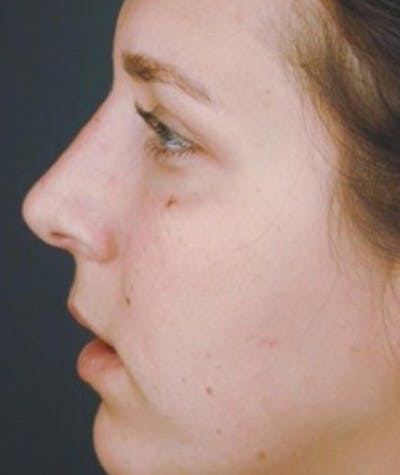 Primary Rhinoplasty Before & After Gallery - Patient 108174466 - Image 2