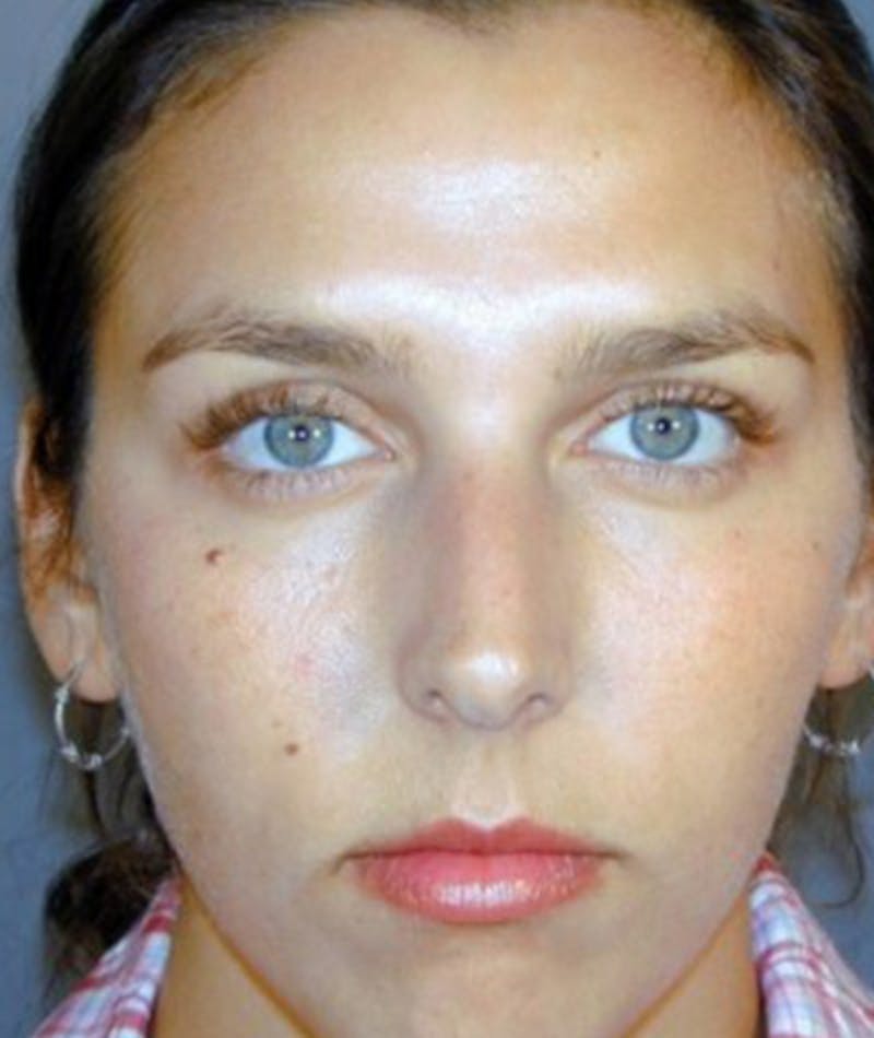 Primary Rhinoplasty Before & After Gallery - Patient 108174466 - Image 3