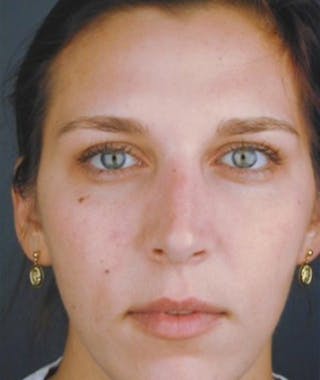 Primary Rhinoplasty Before & After Gallery - Patient 108174466 - Image 4