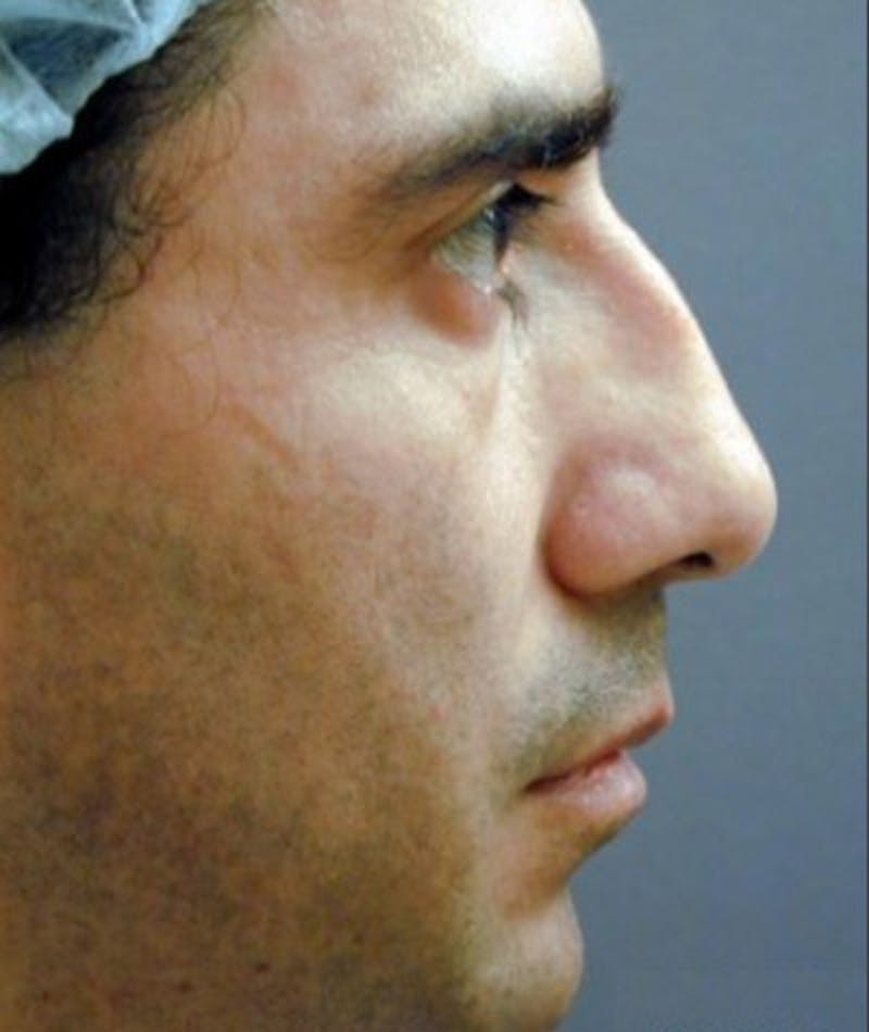Primary Rhinoplasty Before & After Gallery - Patient 108174468 - Image 1