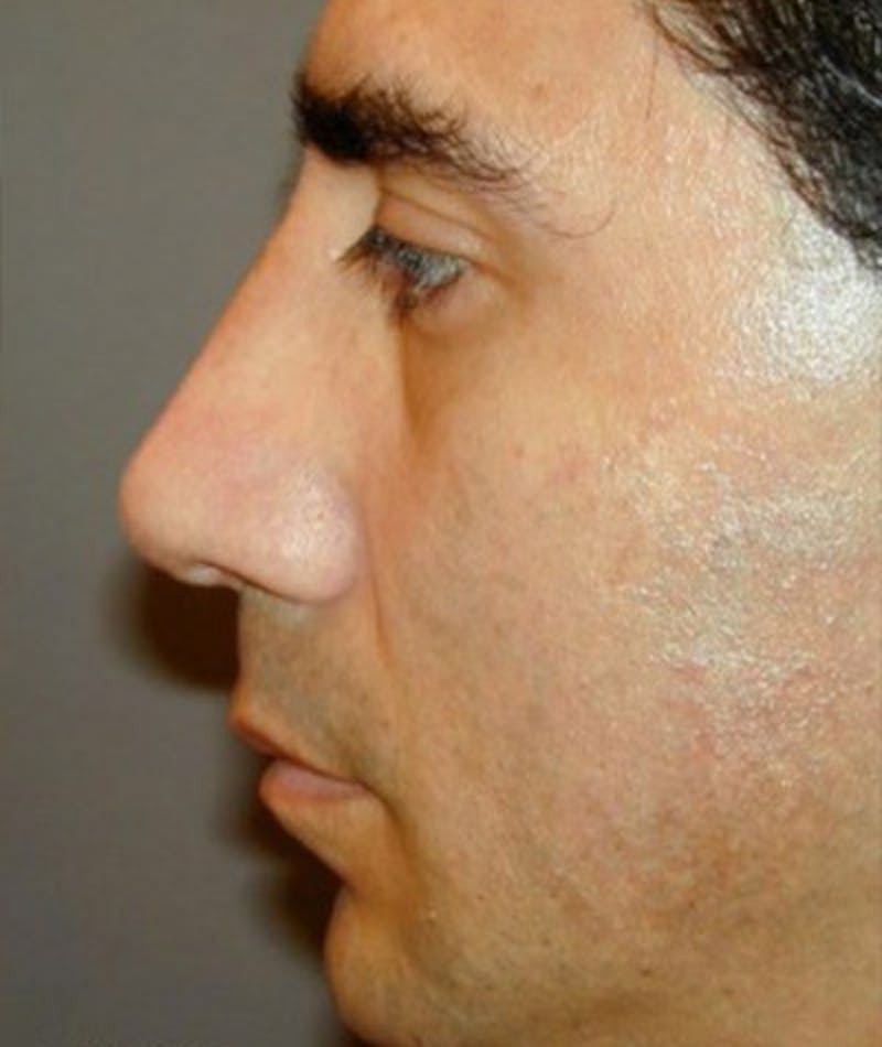 Primary Rhinoplasty Before & After Gallery - Patient 108174468 - Image 2