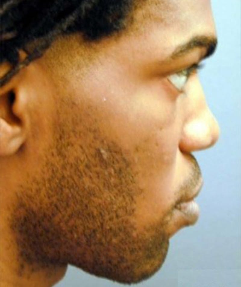 Primary Rhinoplasty Before & After Gallery - Patient 108174469 - Image 1