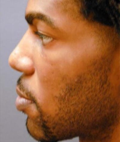 Primary Rhinoplasty Before & After Gallery - Patient 108174469 - Image 2