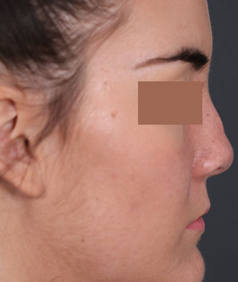 Primary Rhinoplasty Before & After Gallery - Patient 108174470 - Image 1