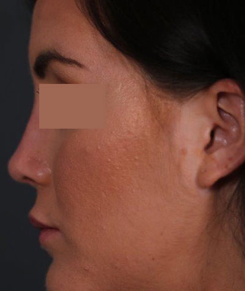 Primary Rhinoplasty Before & After Gallery - Patient 108174470 - Image 2