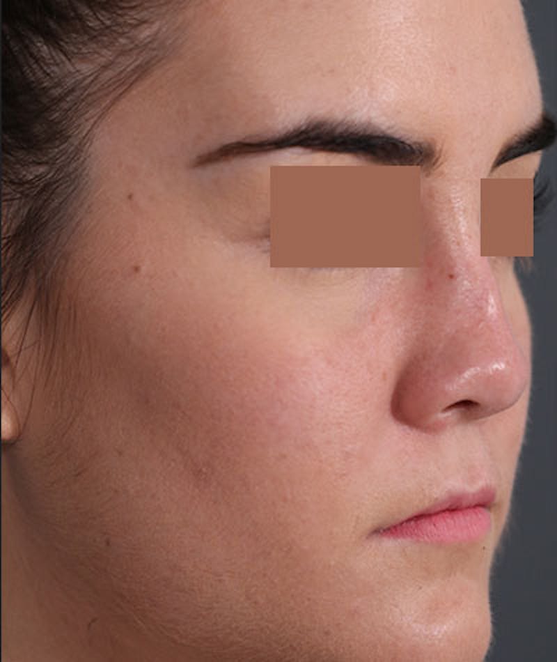 Primary Rhinoplasty Before & After Gallery - Patient 108174470 - Image 3