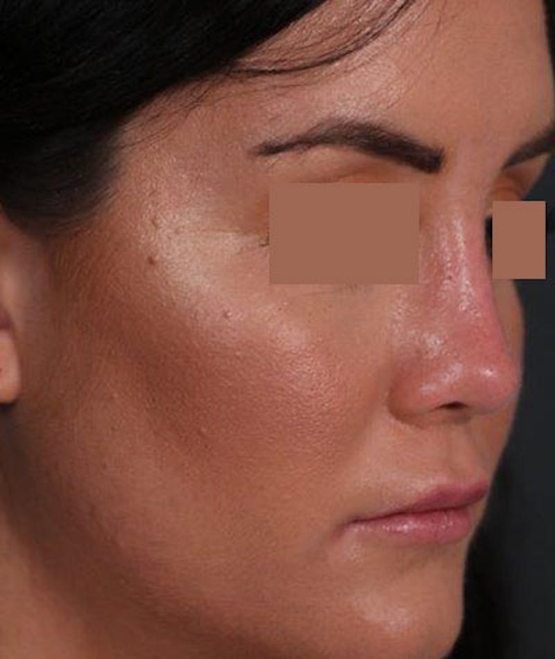 Primary Rhinoplasty Before & After Gallery - Patient 108174470 - Image 4